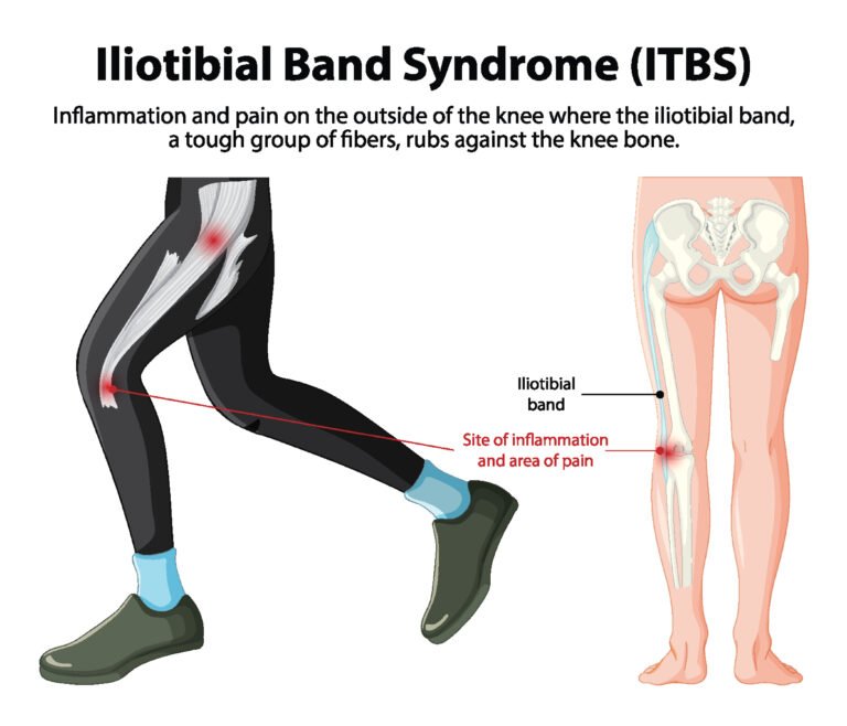 syndrome de la bandelette ilio-tibiale, Le syndrome de l’essuie-glace