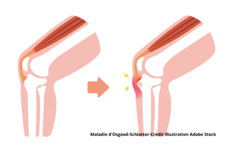 Maladie d'Osgood-Schlatter