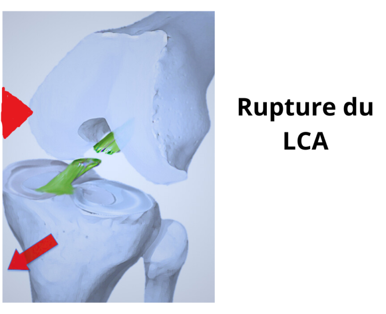 Rupture du ligament croisé antérieur