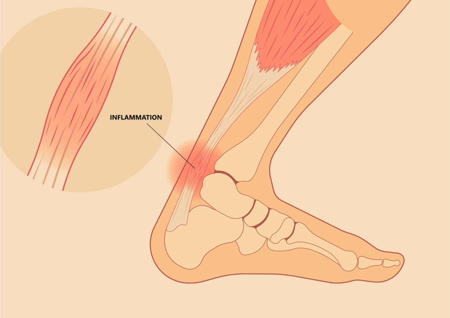 Tendinopathie calcanéenne