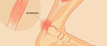 Tendinopathie calcanéenne : causes, symptômes et traitements