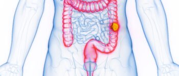 Exercice physique et Cancer du Côlon