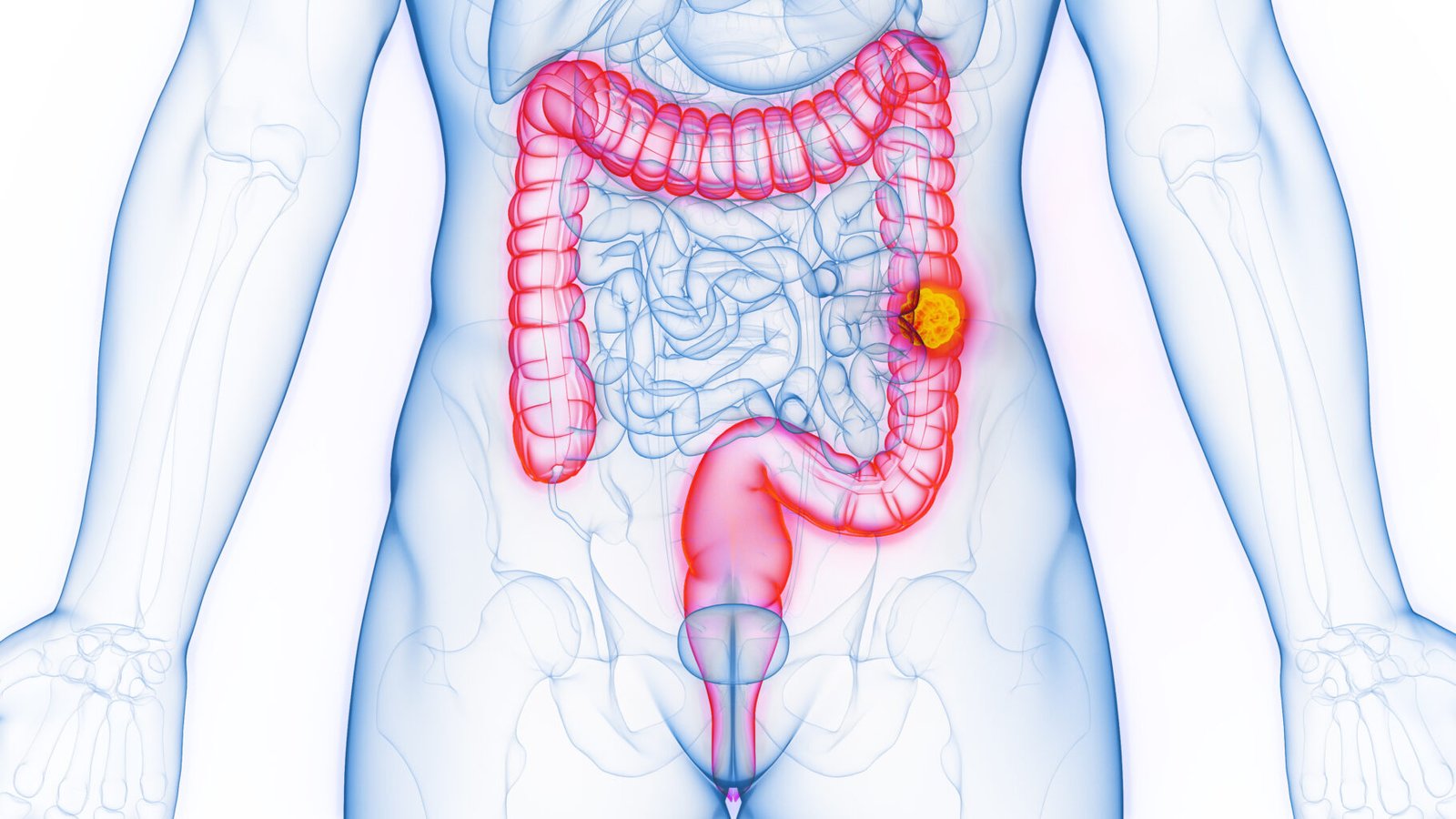 activité physique et cancer du colon