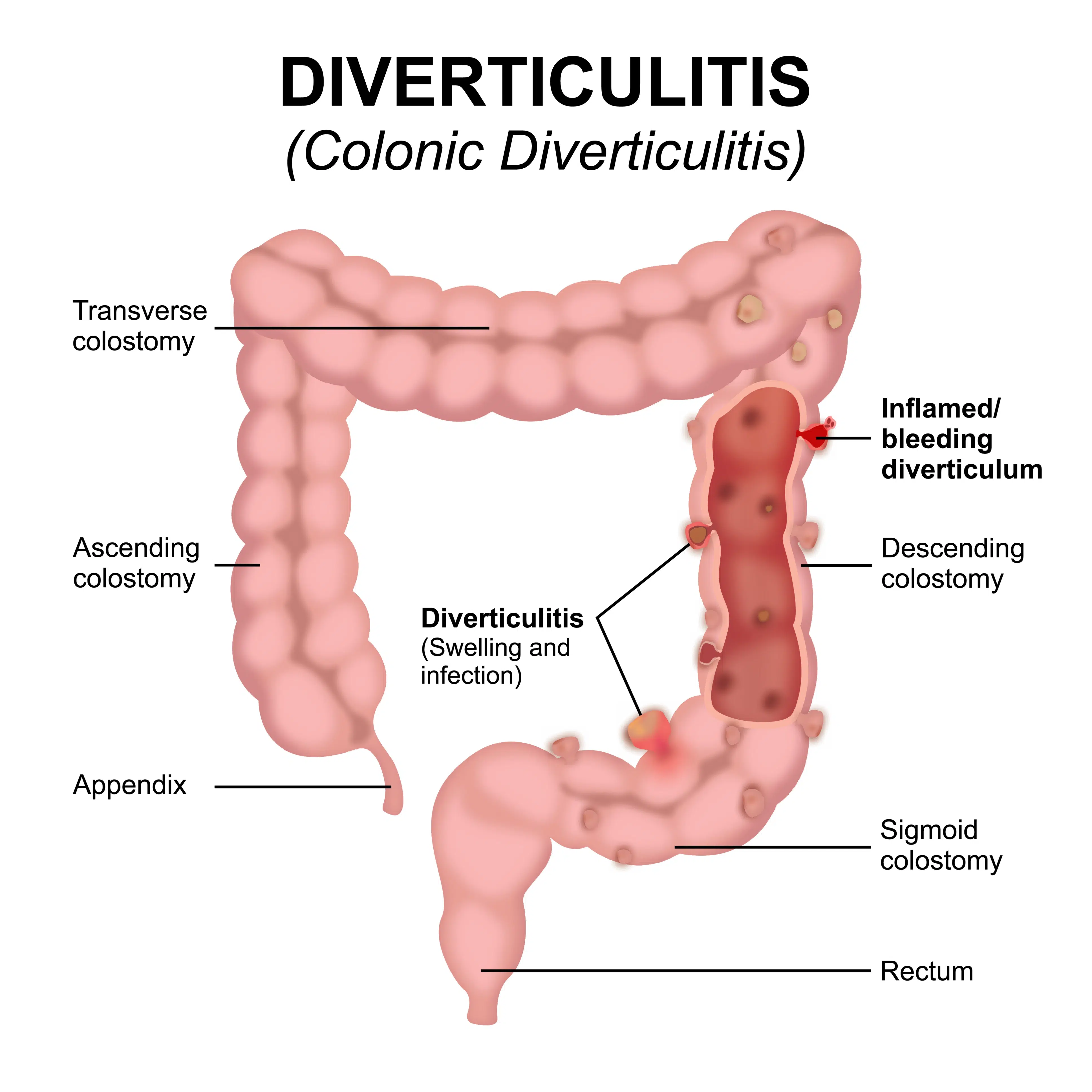 Diverticulite : agir vite, mieux prévenir 3 Diverticulite : inflammation et infection d'un diverticule du côlon sigmoïde