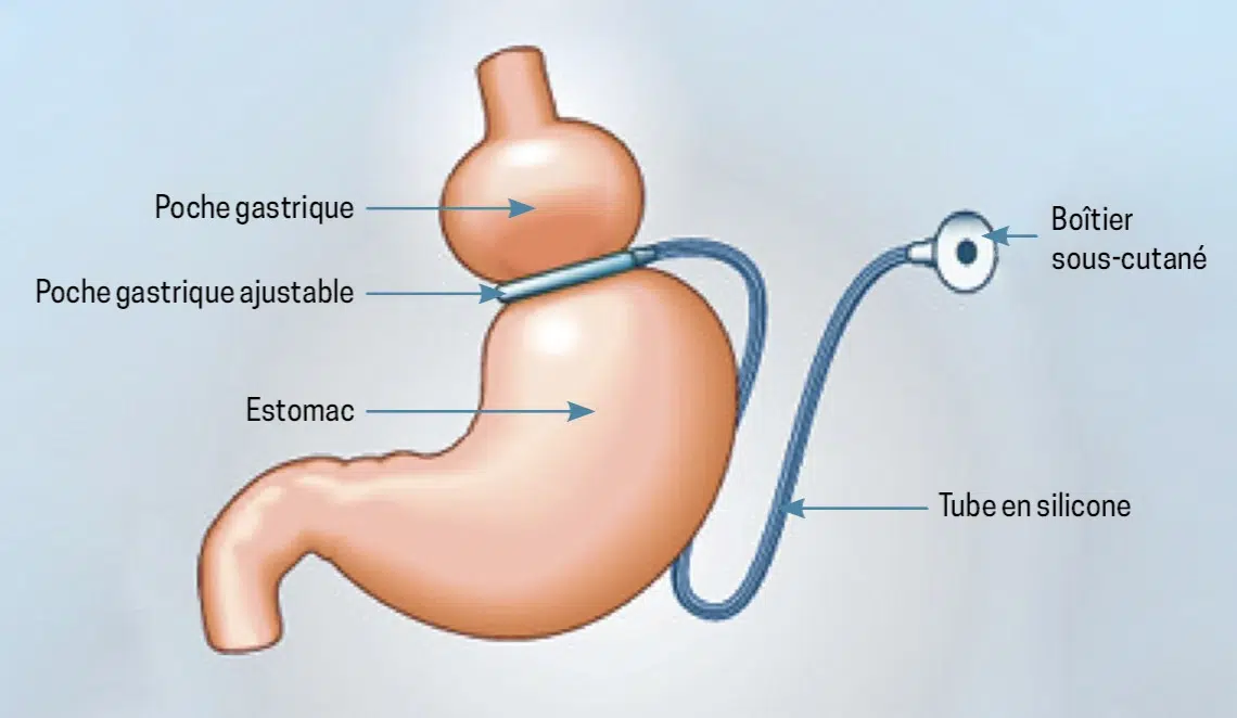 Sch&eacute;ma de l'anneau gastrique ajustable plac&eacute; autour de la partie haute de l'estomac, avec son bo&icirc;tier de r&eacute;glage sous-cutan&eacute;