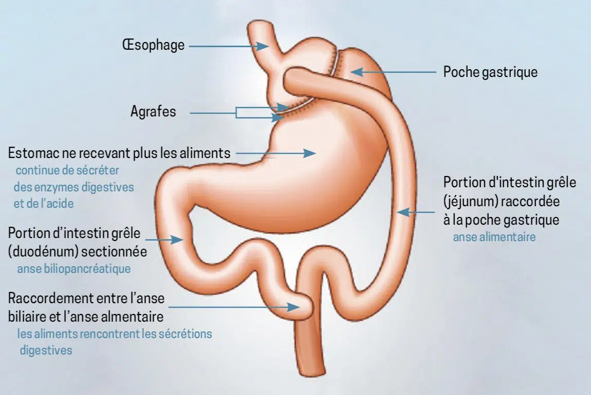 Sch&eacute;ma du bypass gastrique Roux-en-Y : petite poche gastrique reli&eacute;e directement &agrave; l'intestin gr&ecirc;le, court-circuitant l'estomac et le duod&eacute;num
