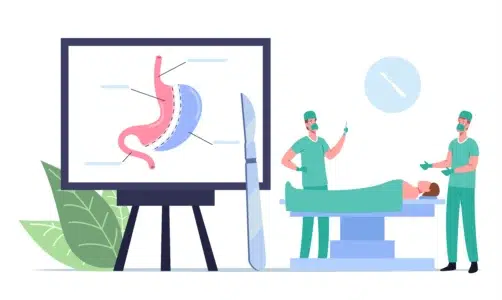 Notre blog 23 Chirurgie bariatrique