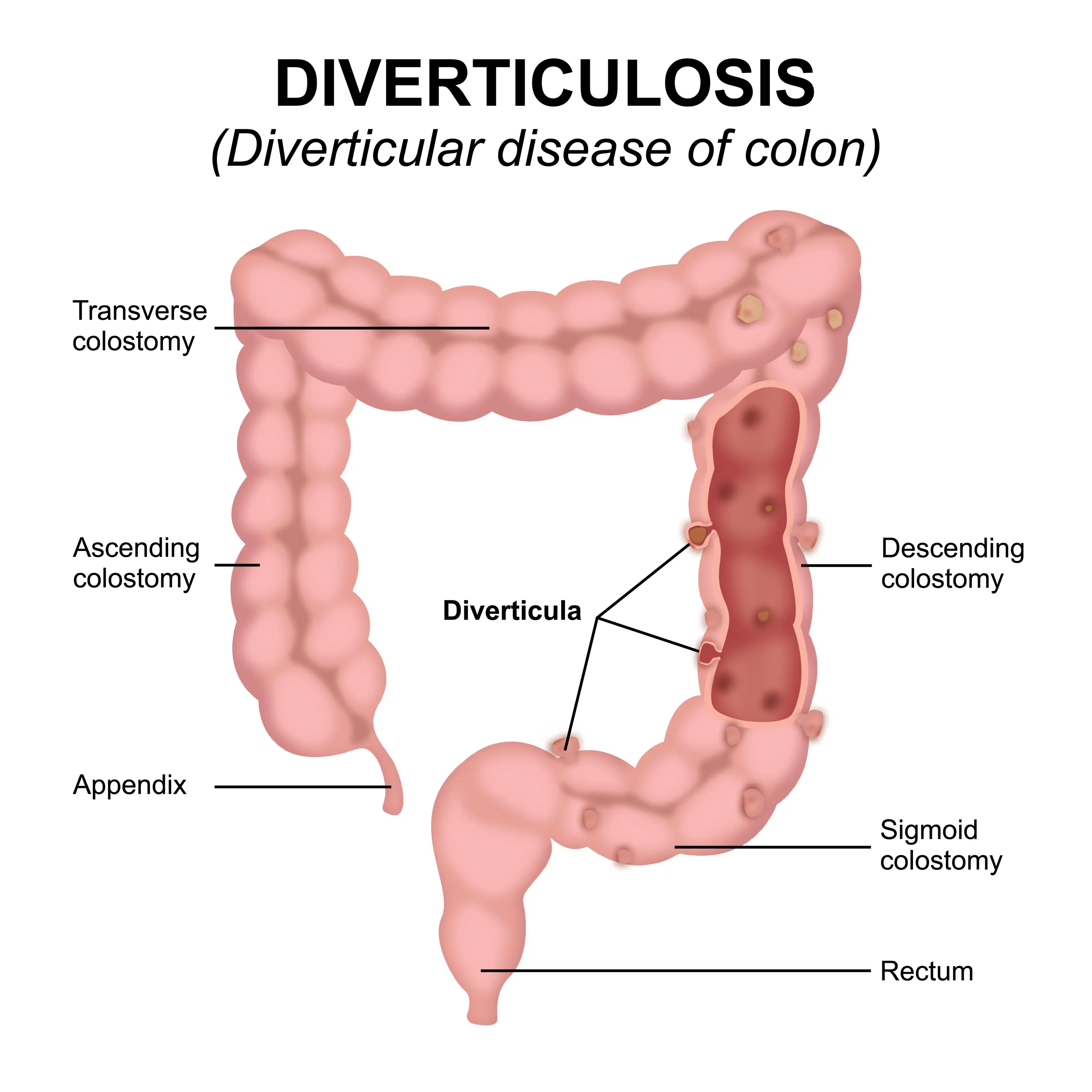 Diverticulite : agir vite, mieux prévenir 2 Schéma d'une diverticulose : diverticules formés sur la paroi du côlon sigmoïde