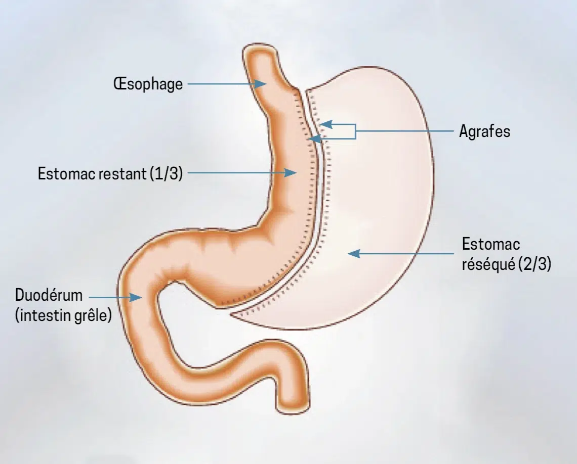 Sch&eacute;ma de la sleeve gastrectomie : retrait de la partie externe de l'estomac, qui prend la forme d'un tube vertical &eacute;troit
