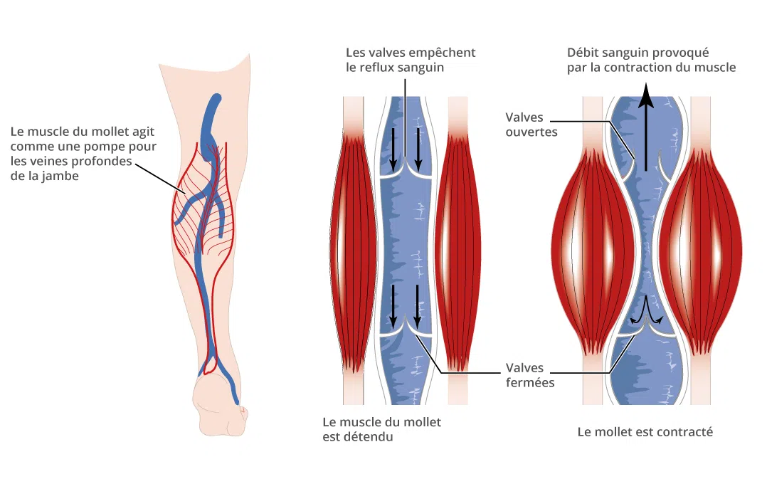 Sch&eacute;ma illustrant les varices : veines superficielles des jambes dilat&eacute;es et tortueuses li&eacute;es &agrave; une insuffisance veineuse