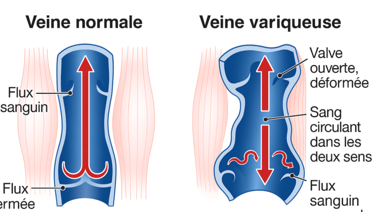 Sch&eacute;ma du m&eacute;canisme des varices : reflux veineux li&eacute; &agrave; la d&eacute;faillance des valvules et dilatation de la veine