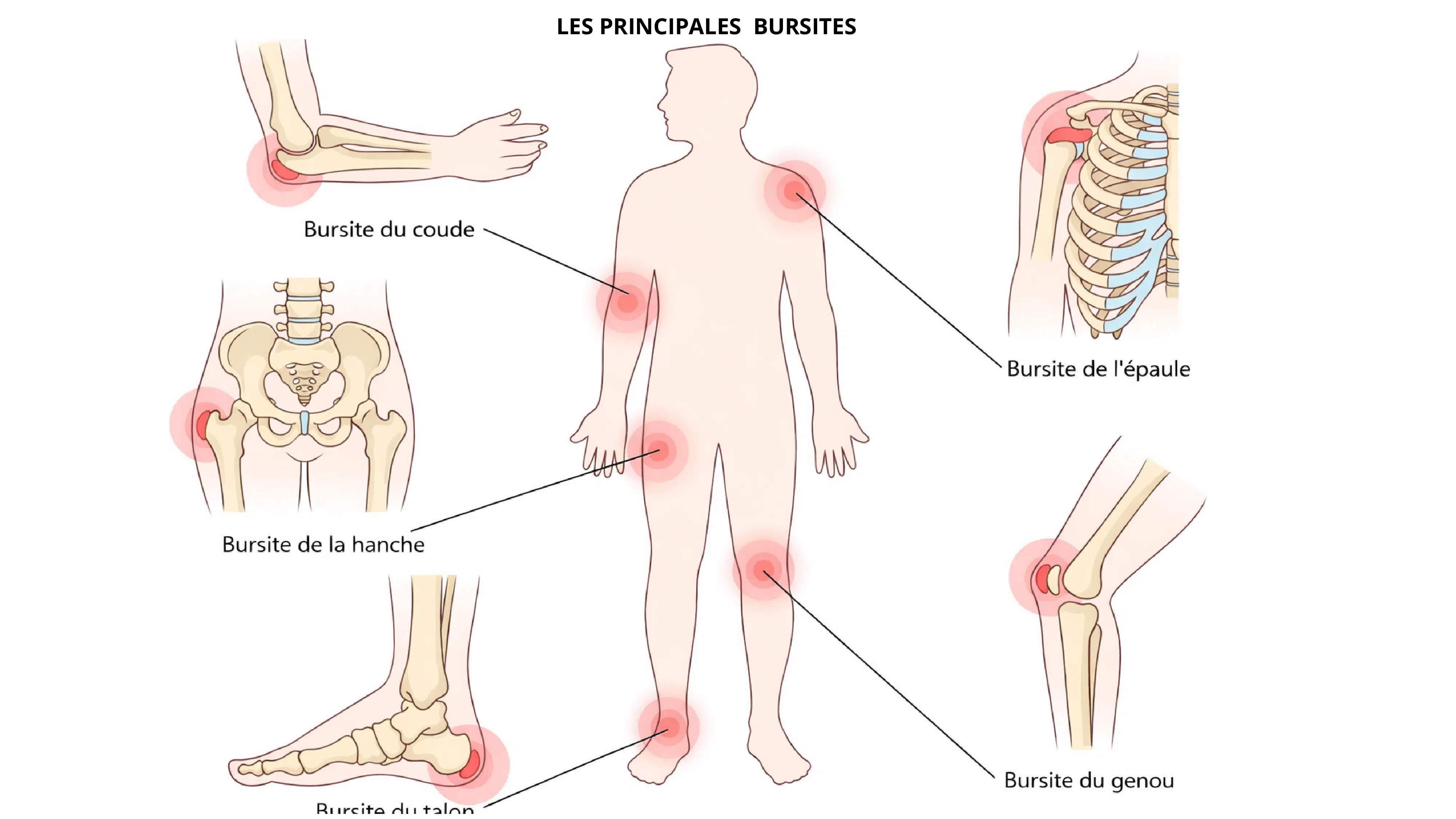 Les principales bursites du sportif : bourse subacromiale (épaule), olécrânienne (coude), trochantérienne (hanche) et prépatellaire (genou)