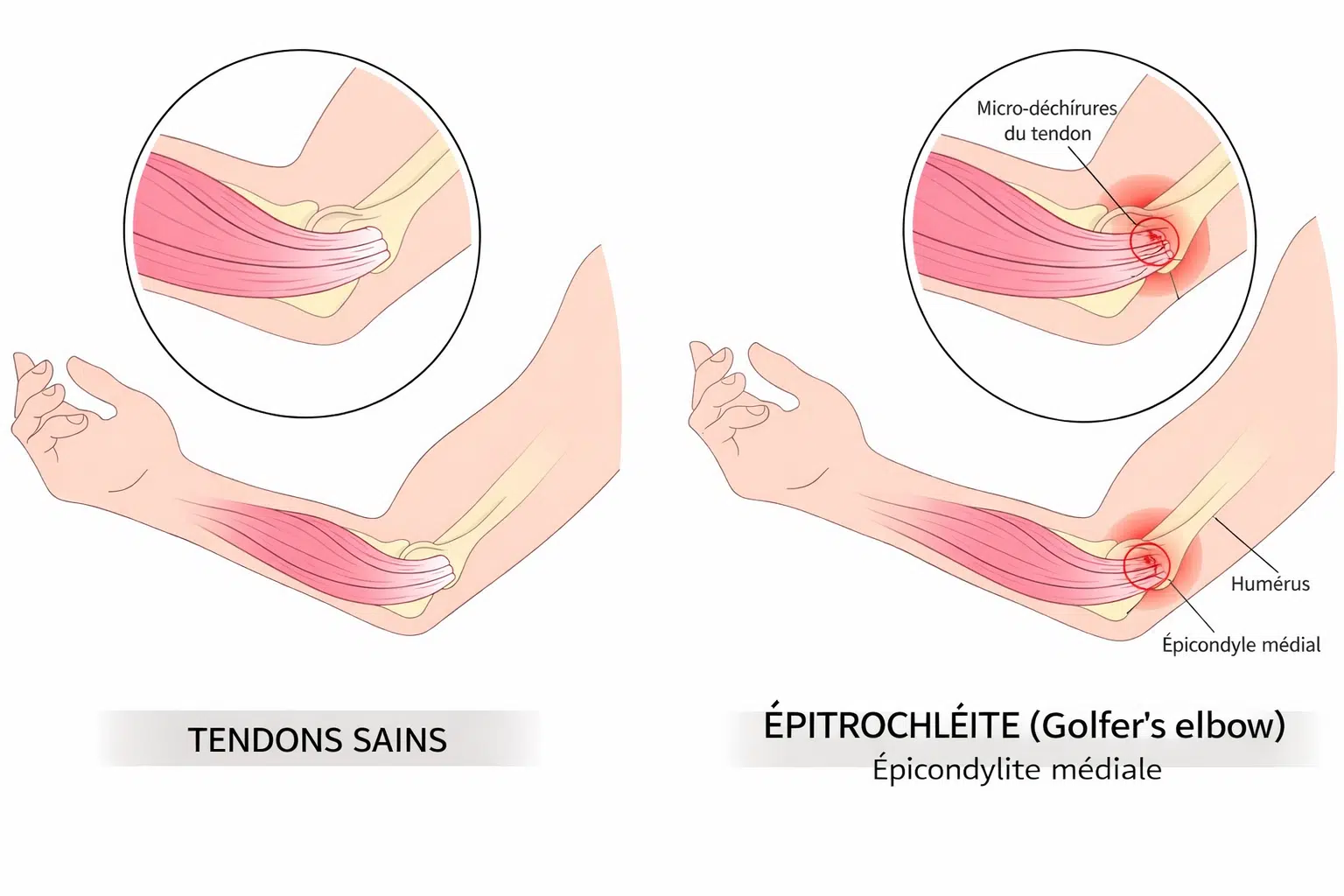 Douleurs du coude : épitrochléite, causes et traitement 2 Épitrochléite:,Douleurs du coude,Douleur coude interne