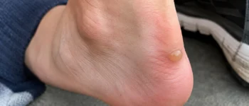 Ampoules aux pieds : prévenir, percer ou soigner
