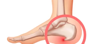 Épine calcanéenne : cause de la douleur au talon ?