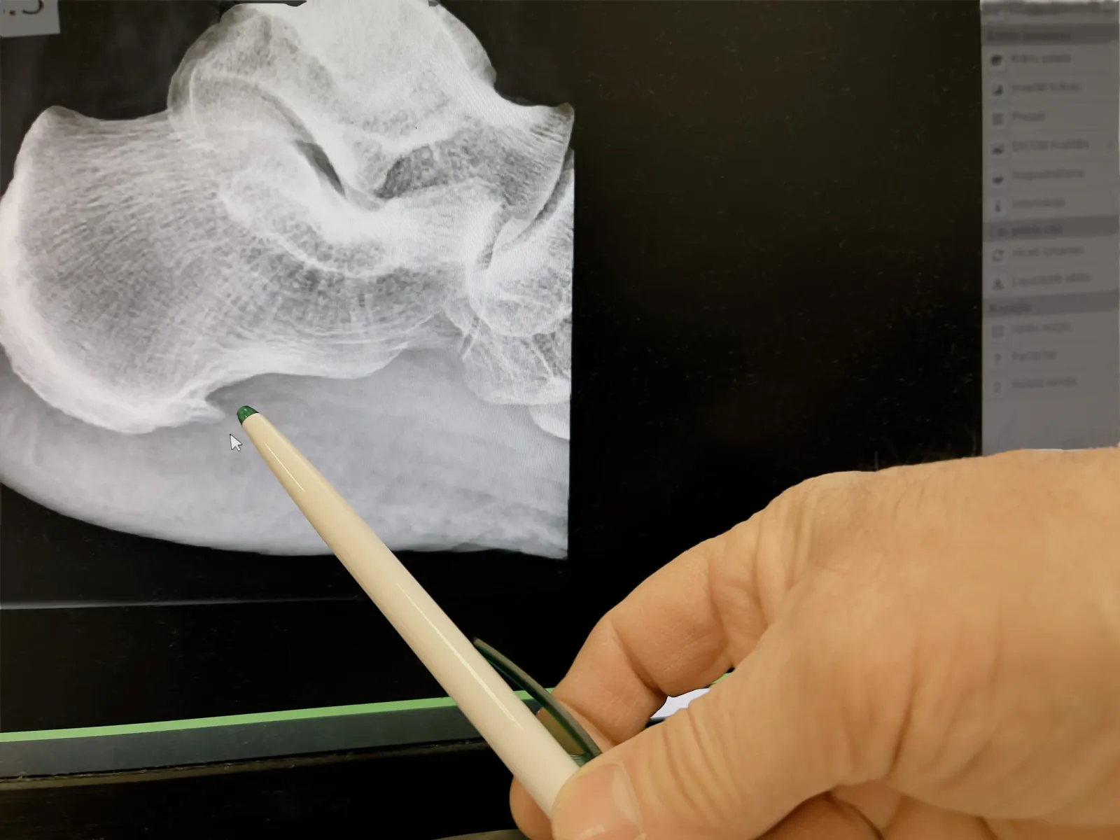 Radiographie de profil du pied montrant une épine calcanéenne, excroissance osseuse sous le calcanéus au niveau du talon