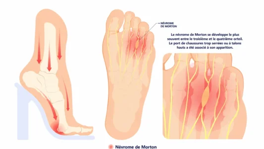Nos derniers articles (Sport&Santé) 14 névrose de morton
