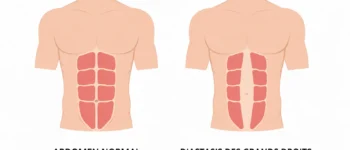 Diastasis abdominal homme : guide pratique du sportif en reprise (exercices + traitement)