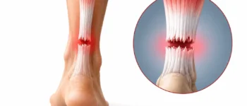 Rupture du tendon d&rsquo;Achille : protocole de récupération et reprise du sport semaine par semaine